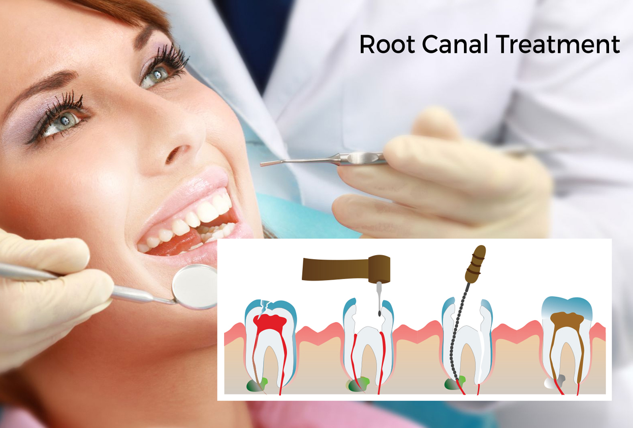 Root Canal Treatment