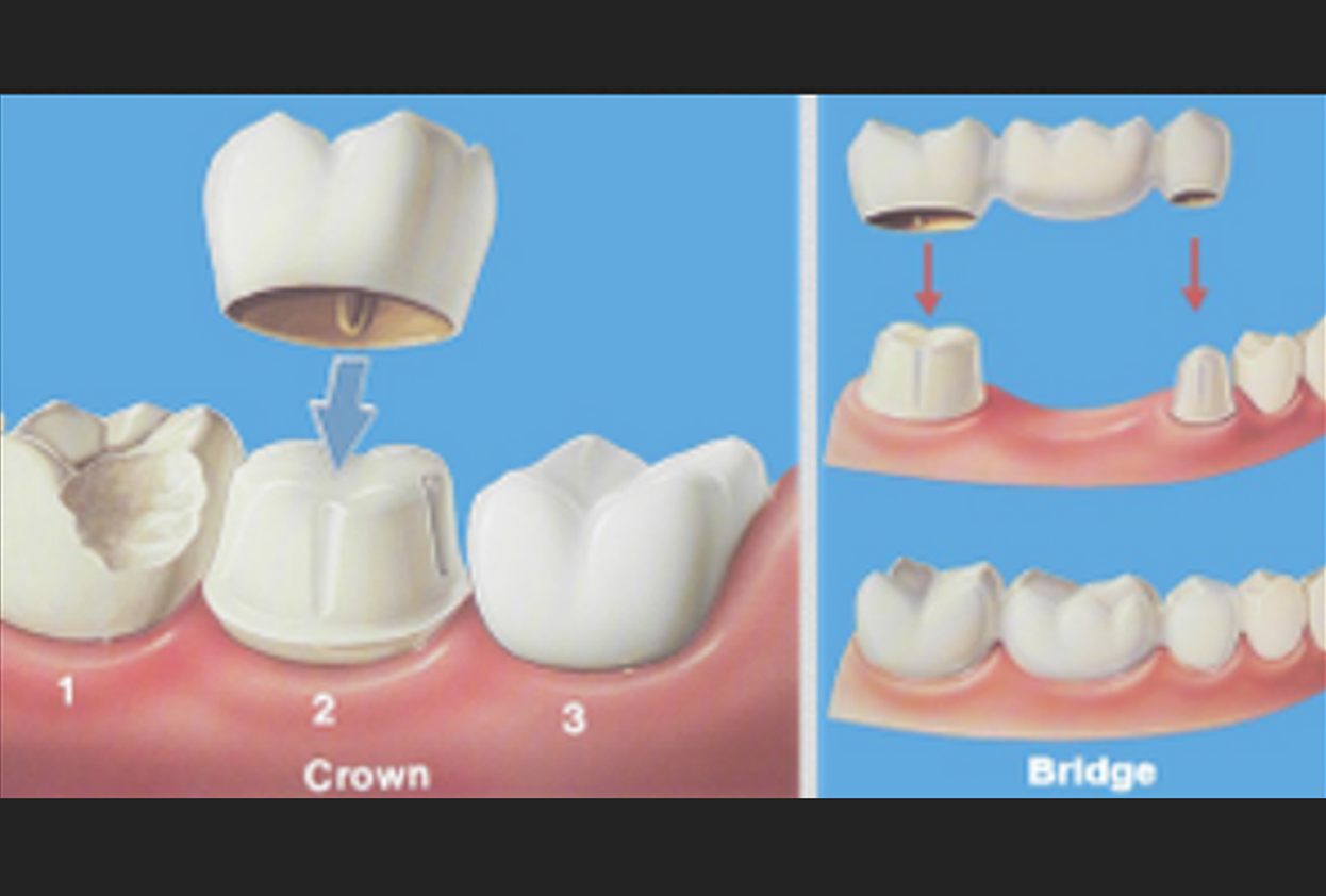 Crowns and Bridges